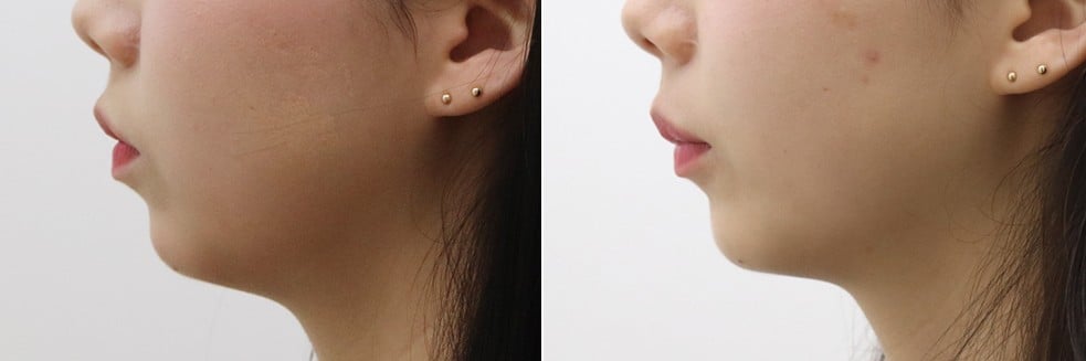 ภาพก่อน-หลังของ Evers