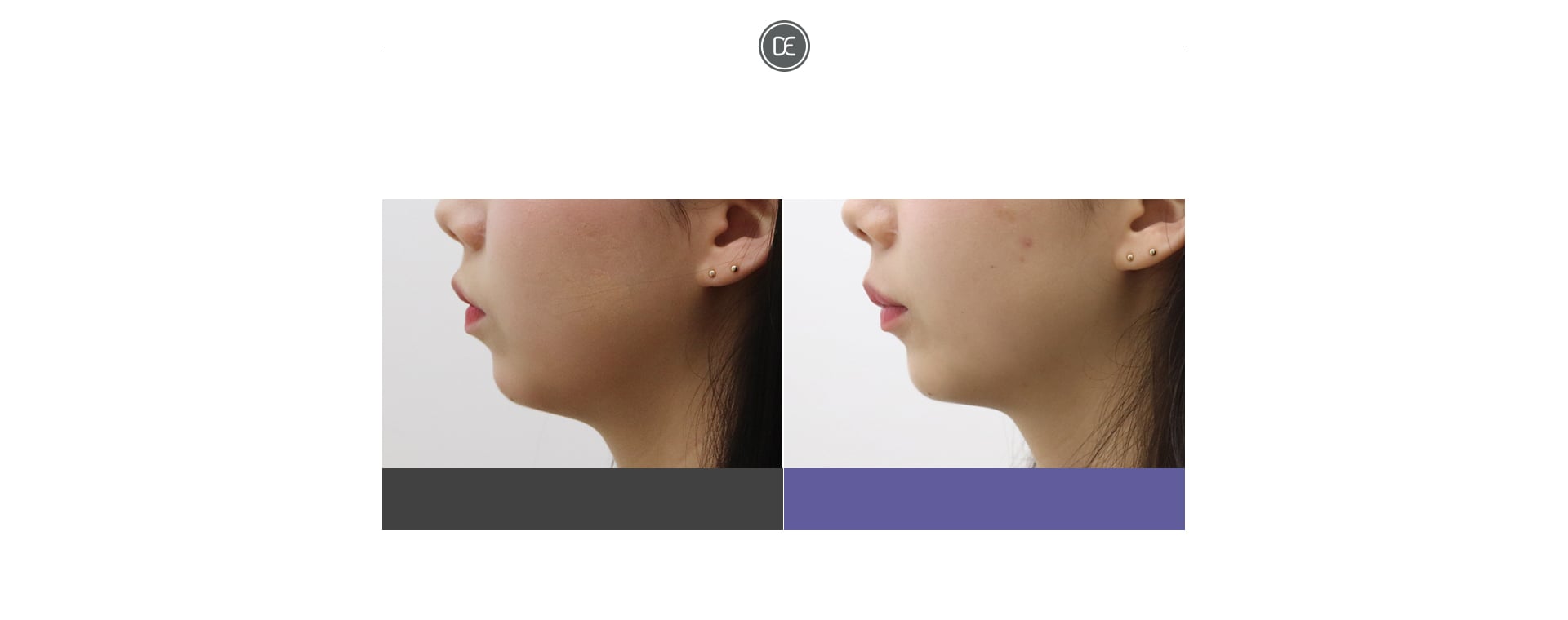 ภาพก่อนและหลังฉีดปรับรูปหน้าเอเวอร์ส 1